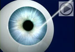 Bladeless_lasik
