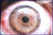 Nashville laser eye surgery