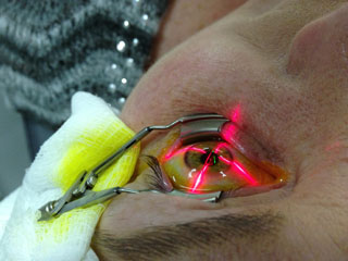 cross-linking, for keratoconus and keratoectasia after LASIK 