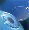 Tennessee Intralase Photo 3